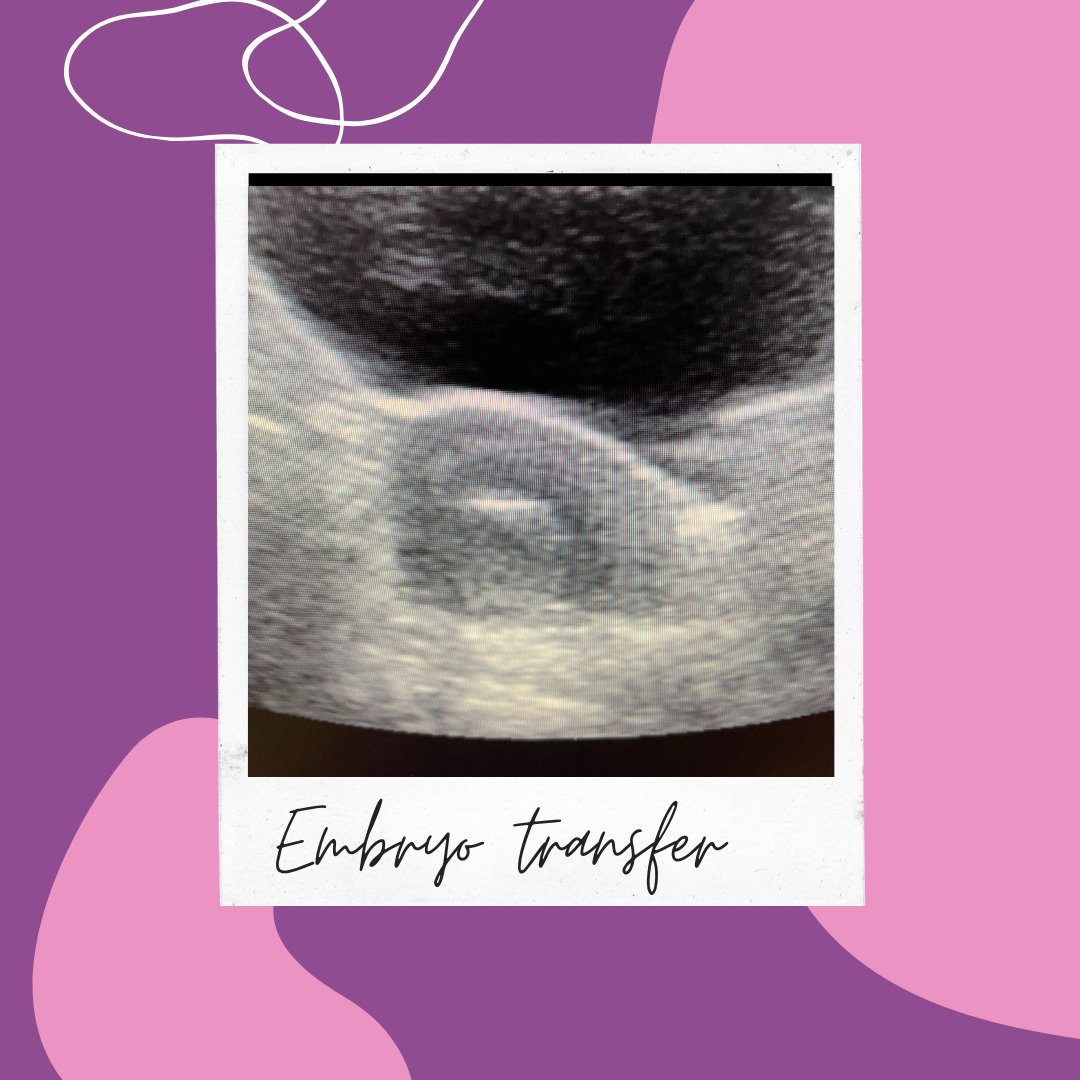 The embryo transfer technique is very important 
Many of my patients say “pregnant until proven otherwise”
#embryotransfer #ttc  #pupo