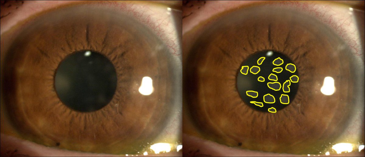 DrJavierHurtado's tweet photo. Las conjuntivitis infecciosas pueden dejar secuelas como estas cicatrices en la córnea (en amarillo). Quitan visión porque es lo mismo que tener las gafas sucias con manchas.@Clínica Rementería #oftalmologiahurtado #oftalmologiapediatrica #oftalmologiainfantil #leucoma #pediatria https://t.co/rutbutpxKj