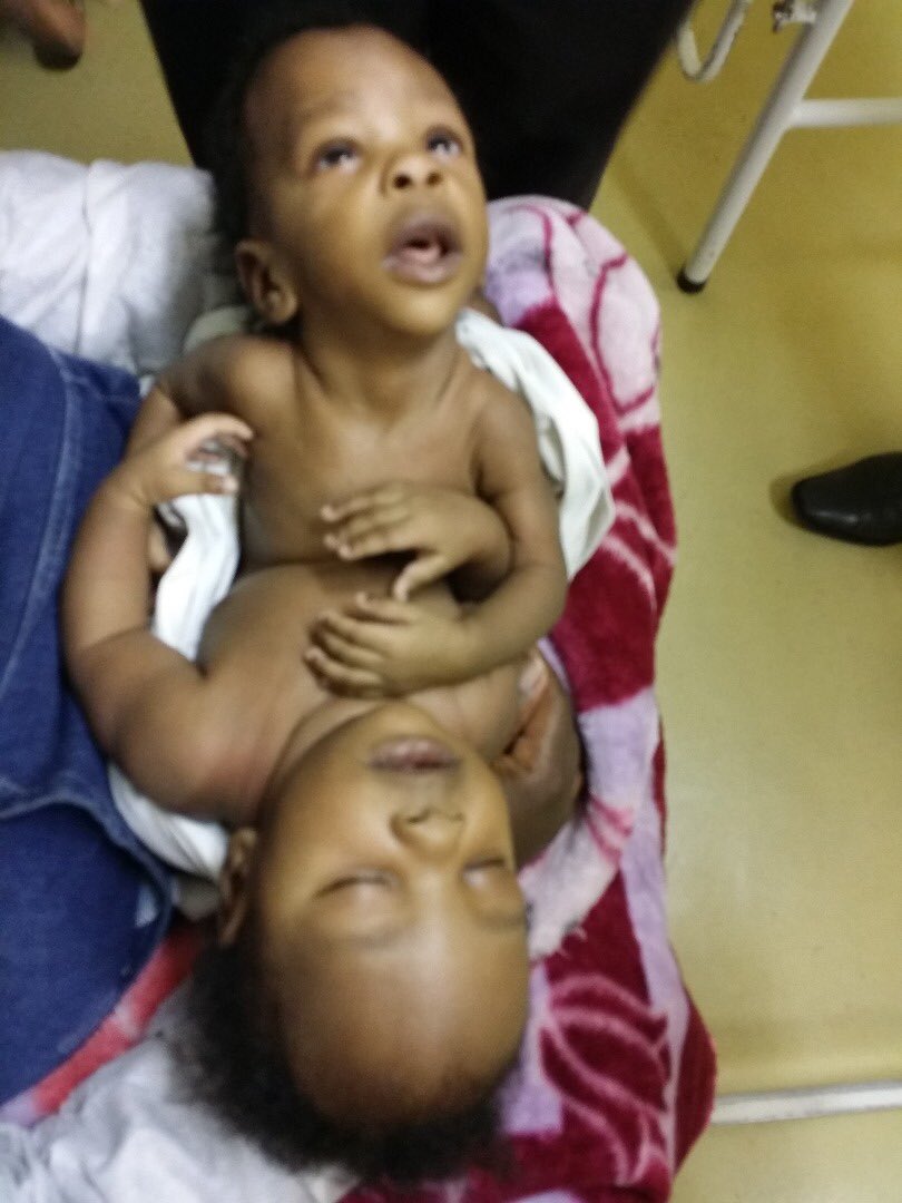 Seven years ago, paediatric surgeons in Zimbabwe separated a set of thoracopagus conjoined twins in an eight hour operation at Harare Children’s Hospital.