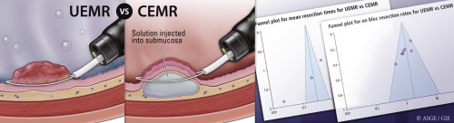 Choi et al compare “Underwater versus conventional EMR for colorectal polyps” in their recently published article. giejournal.org/article/S0016-…