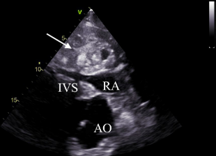 EquineCardio's tweet photo. A fascinating case study of a hemangiosarcoma in a horse RV which initially presented as bilateral nasal discharge and tongue swelling #biom4180
https://t.co/hnY9gPDYYm https://t.co/4WtvozIviJ