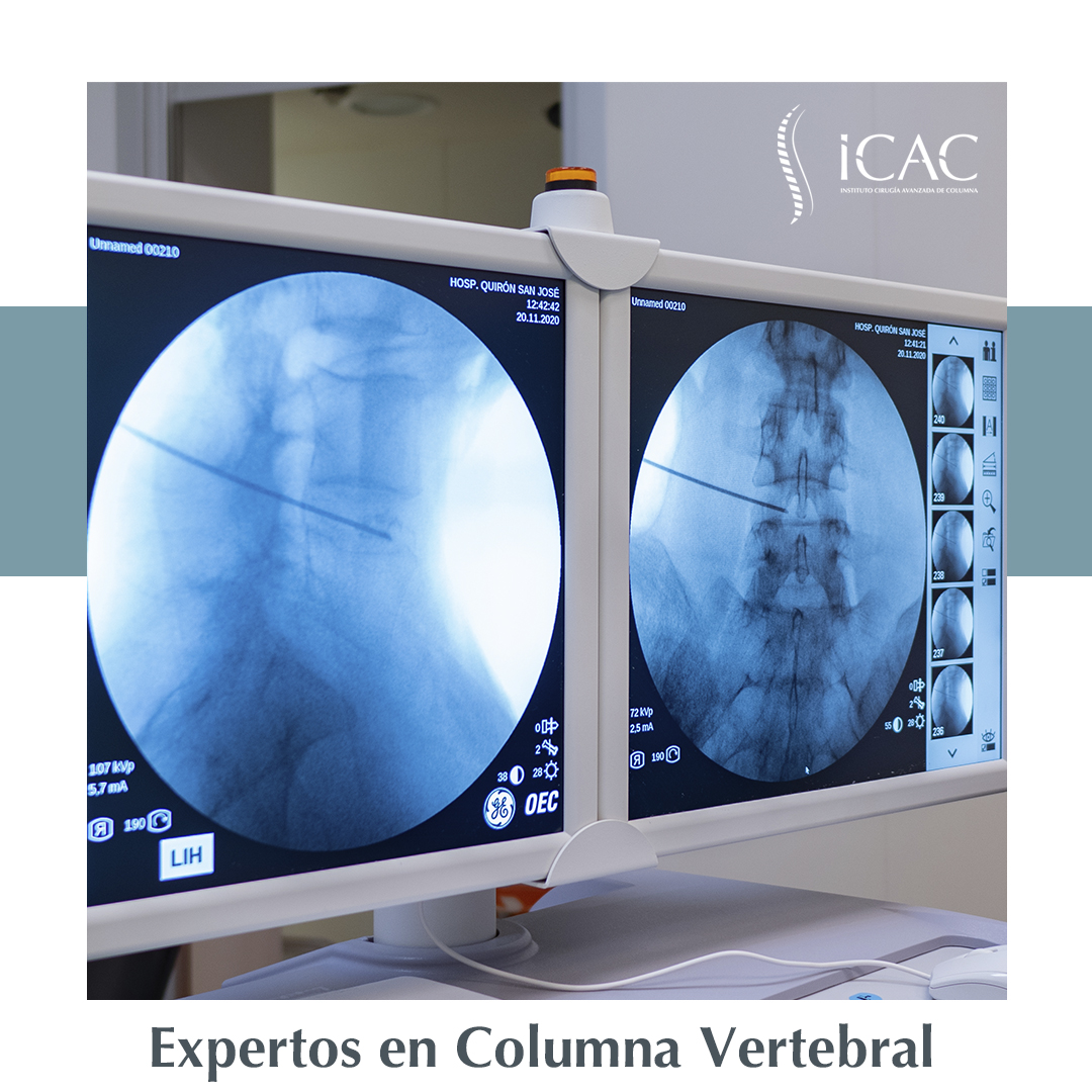 InstitutoCAC_'s tweet photo. Intervenciones de columna tras las cuales, ‼️te marchas andando a casa. ‼️

"La revolución de la cirugía de columna vertebral ha llegado con las intervenciones ultra-mínimamente invasiva."

#endoscopiadecolumna #minimamenteinvasivo #NoInvasiva #cirugiadecolumna https://t.co/1JPkRB2BxU
