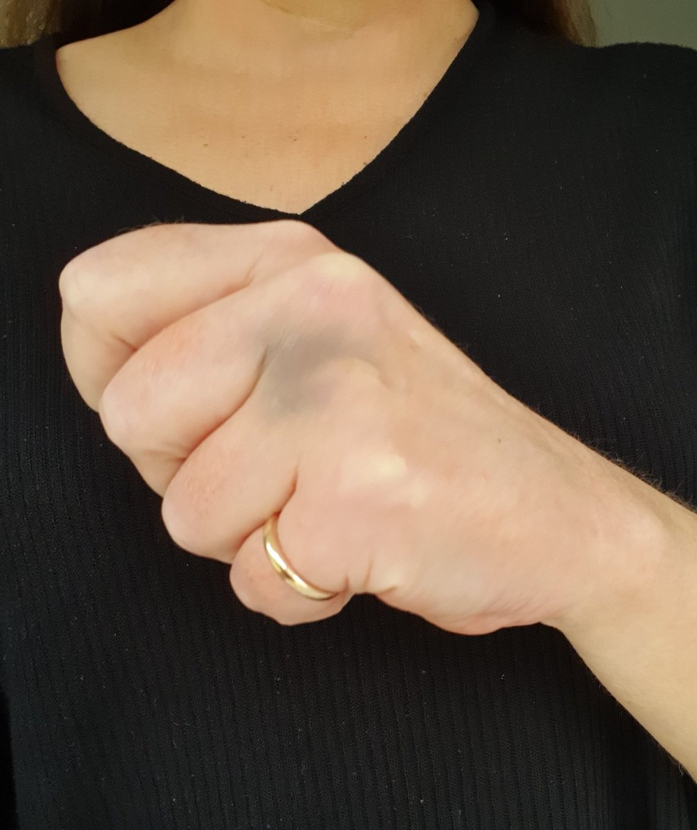 Oh, hello random unexplained bruise on my knuckles! This is a probably a sign that my platelet count is low. It may mean I need a treatment break and/or a dose reduction. I'll find out at my 6 weekly check up next week.  #myelosuppression6/9