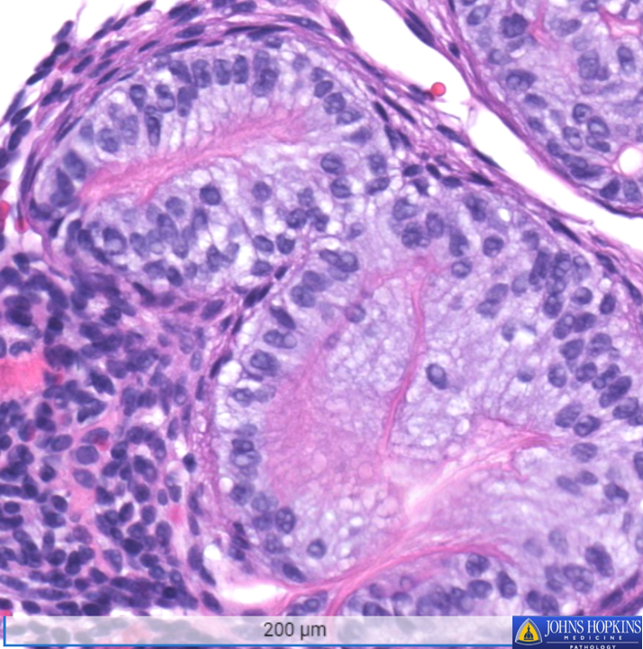 A teenage patient presents with a mandible cyst, shown below. What is your diagnosis? Answer and explanation to follow! #Pathology #MedEd