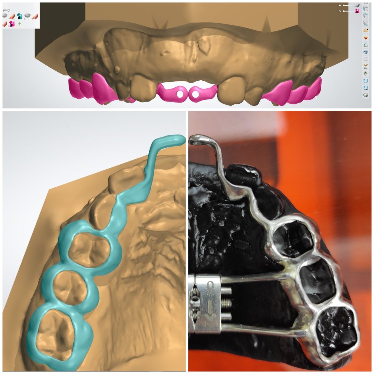 Kurtarma operasyonu başladı. #Gömükdişler #ortodonti <a href="/orthodigi/">Orthodigi Orthodontics Lab</a>