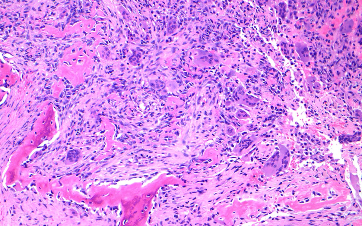 bitar_mireille's tweet photo. Giant cell tumor of bone, what is the commonly seen mutation and the IHC surrogate marker for molecular analysis ? #molecularpath #bonepath #surgicalpath #neuropath #pathtwitter #orthpaedicsurgery #bonetumor #softissuepath #pathology https://t.co/2XsrZl9RbE
