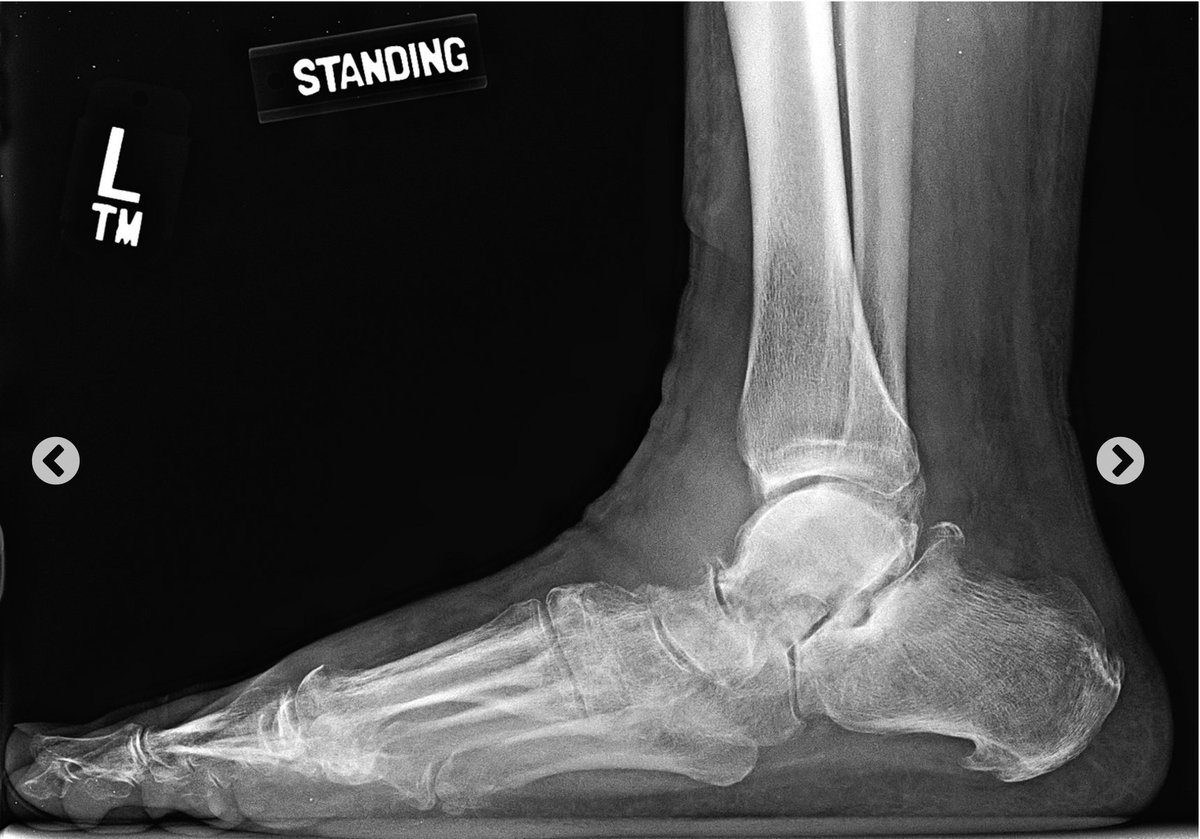 jbjs's tweet photo. JBJS Image Quiz: A 58-Year-Old Man with Foot Numbness Following a Car Accident

https://t.co/yGNCNhkUPq

#JBJSImageQuiz https://t.co/clxcja6qcW