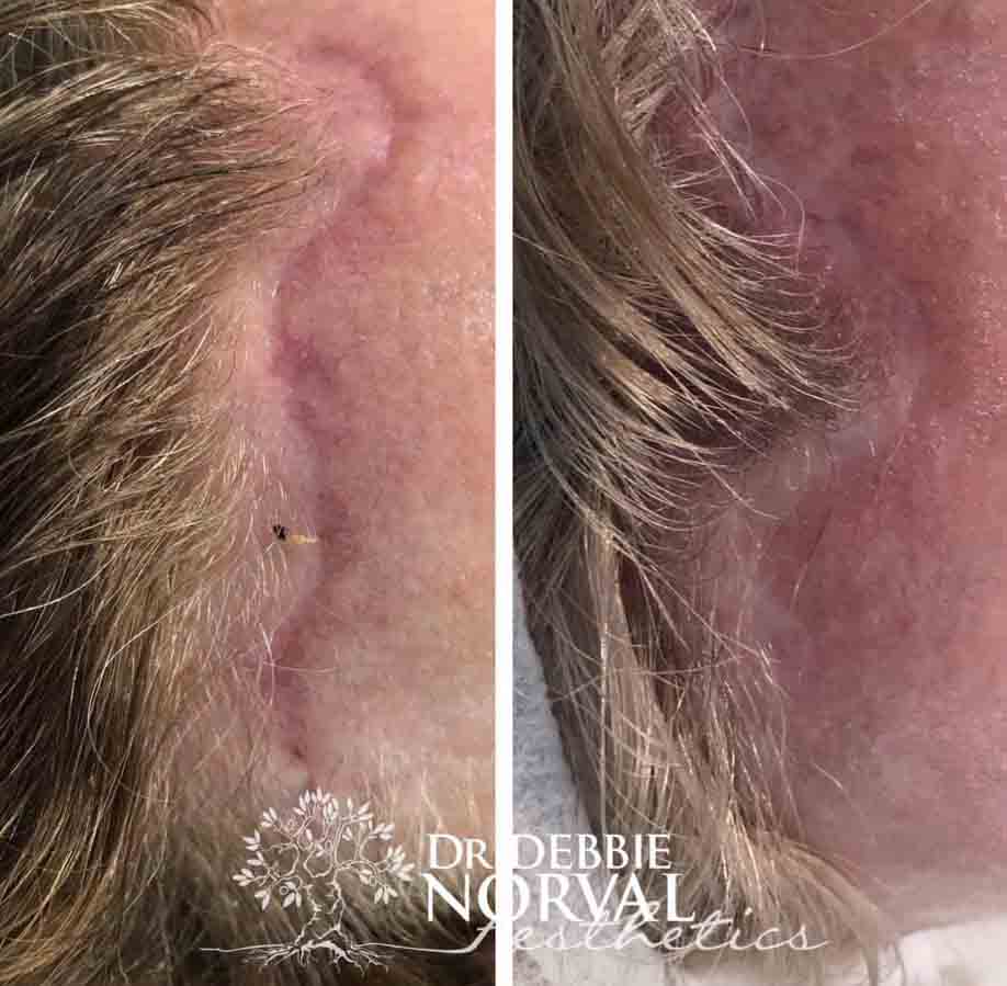 Brow lift scar, before and after three #Tixel treatments.
Tixel® uses fractional thermomechanical ablative technology to tighten skin, iron out wrinkles , improve the appearance of scars and reduce pores. It is also an effective transdermal delivery system. 
#tuesdaytreatment