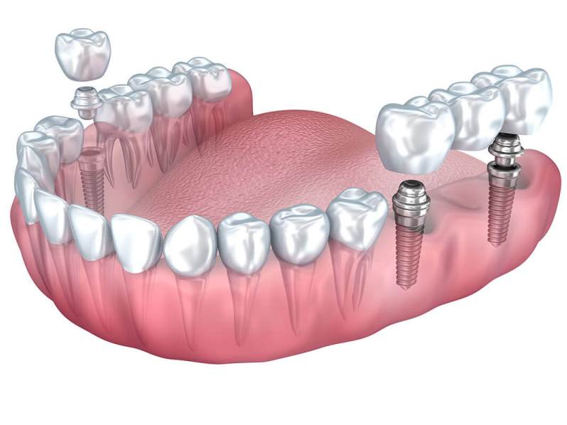 Протез на 2х имплантах. Имплантаты Dentium Superline. Мостовидный протез на 6 имплантах. Классическая двухэтапная имплантация. Мостовидный протез на 4 зуба.