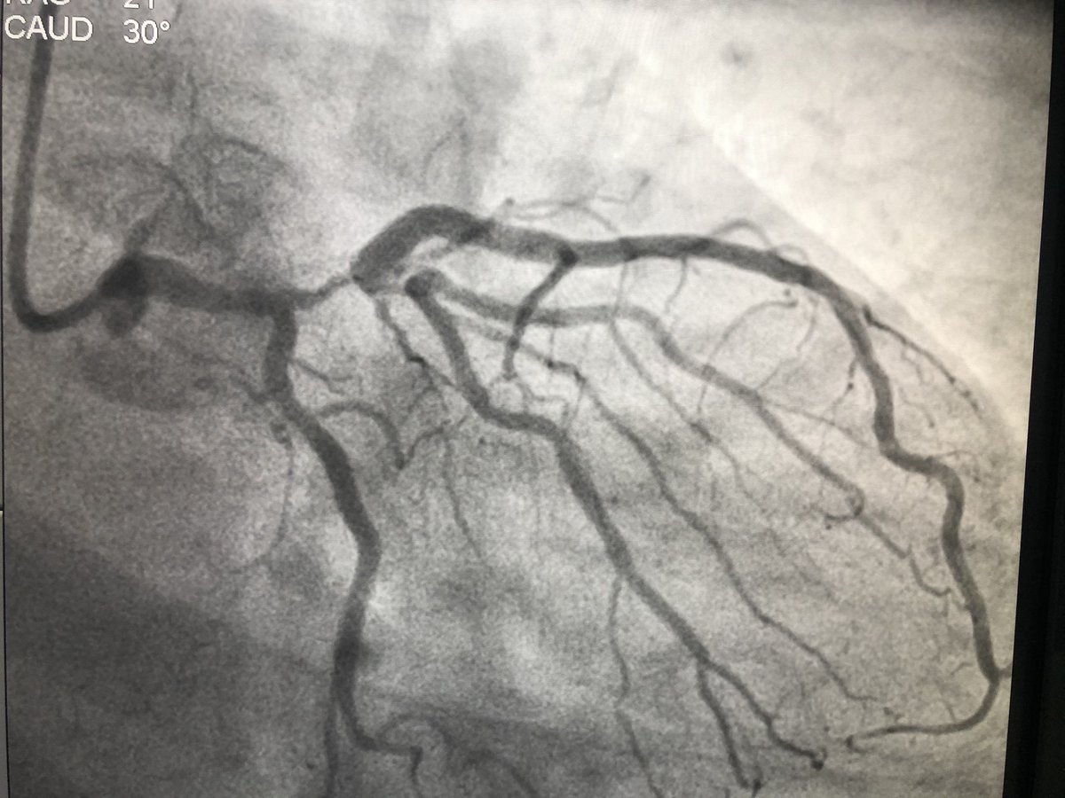Advised a coronary angiography. He got admitted the next day and angio showed critical left main disease and triple vessel disease.  #leftmainCAD