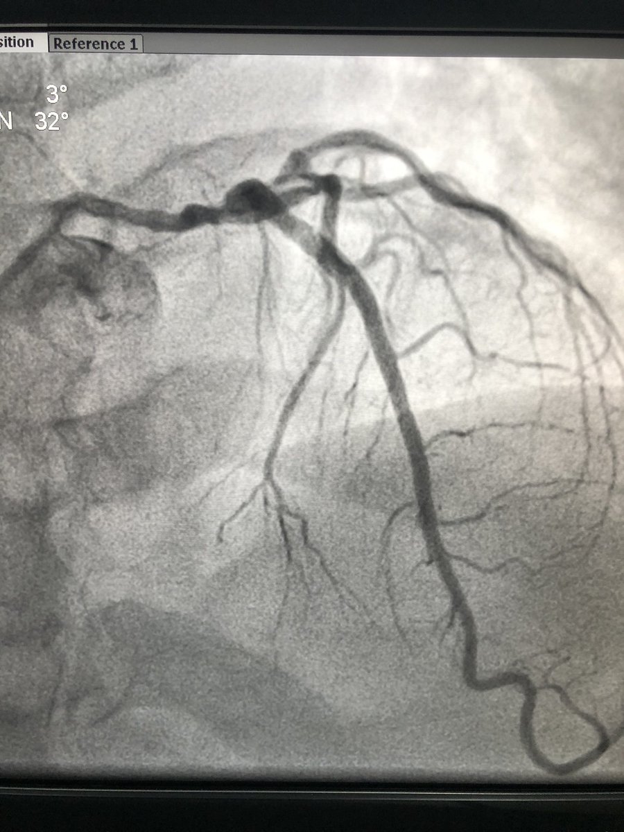 Advised a coronary angiography. He got admitted the next day and angio showed critical left main disease and triple vessel disease.  #leftmainCAD
