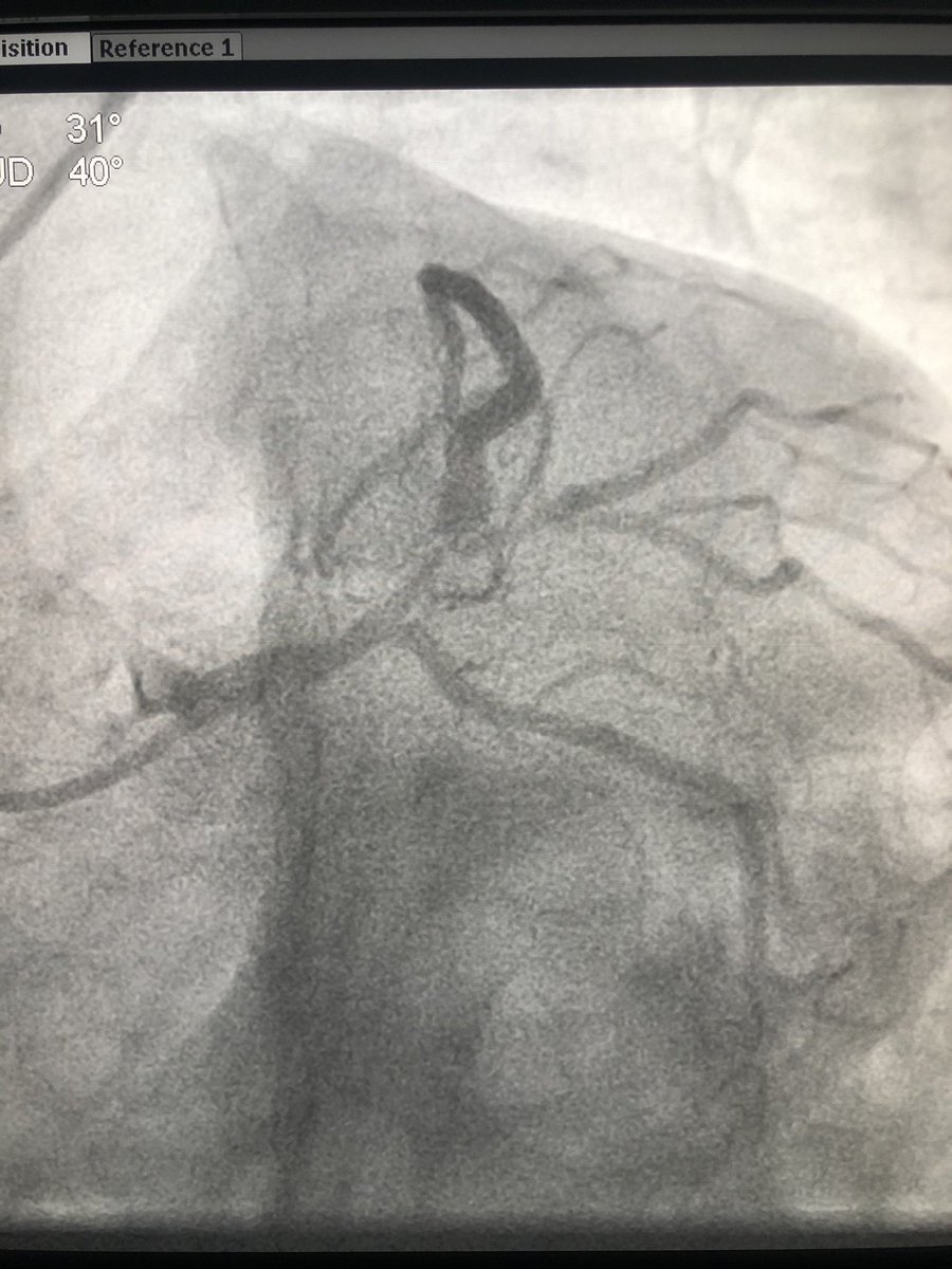 Advised a coronary angiography. He got admitted the next day and angio showed critical left main disease and triple vessel disease.  #leftmainCAD