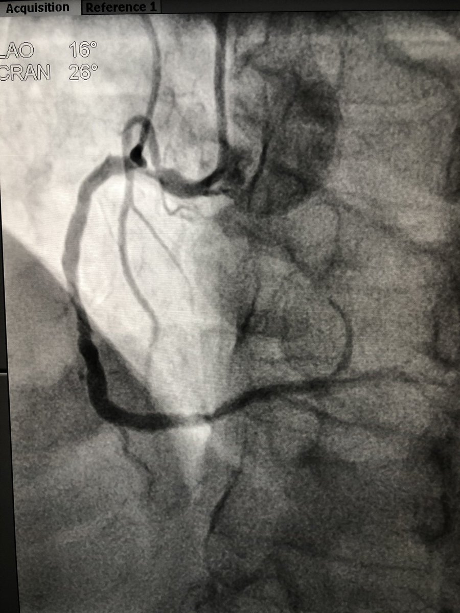 Advised a coronary angiography. He got admitted the next day and angio showed critical left main disease and triple vessel disease.  #leftmainCAD