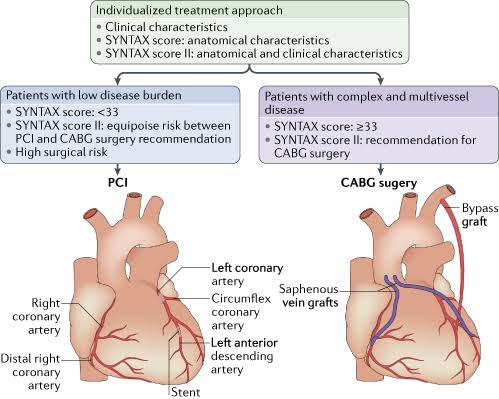 Provisional стентирование. Left main. Pathophysiology of coronary artery disease. Left main. Left main coronary artery.