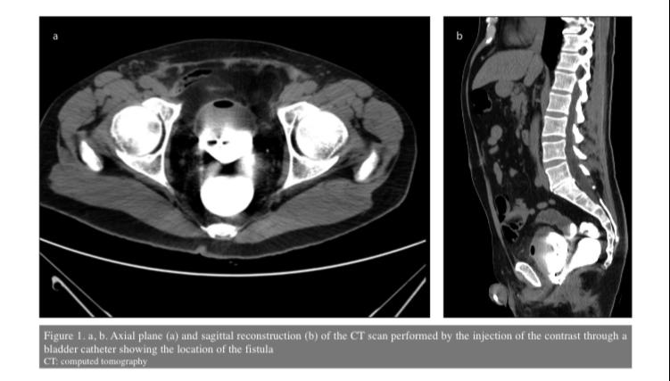 TurkJUrol's tweet photo. Repair of a rectovesical fistula following laparoscopic radical prostatectomy with Martius fat pad flap interposition
#fistula #genitourinary #martius #rectovesical #UroSoMe
@lorurolog @FrancoPalmisan7 @Uroweb @AmerUrological
Article Link :
https://t.co/GOH5xojPW1 https://t.co/o9EgX8QHZ1