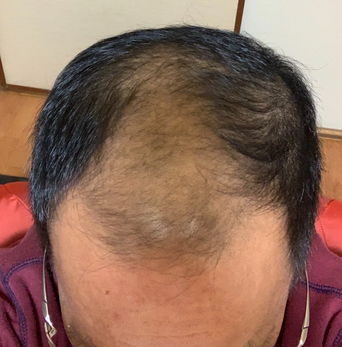 はげくまくん J M A髮活おじさん 43日目 髮活中の親父の頭 なんかしっかりしてきた感じがしない 髪の毛伸ばし中 髪の毛結びたい 髪の毛伸びた 髪の悩み解消 髪の悩み改善 頭皮ケア 髮活日記 黒くなった気がする