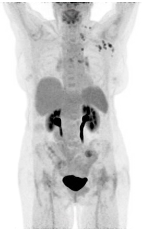 KCLGSTTpet's tweet photo. Response assessment FDG PET-CT = CMR in liver. But...new tiny (sub-cm short axis diameter), morphologically normal FDG avid nodes in L axilla, L inf neck &amp; L hilum/mediastinum. COVID-19 vaccine (<7d). Beware of false +ve nodal uptake!! #PETCT #FOAMed #FOAMrad #FRCR #radres https://t.co/mVMVaEHdqN