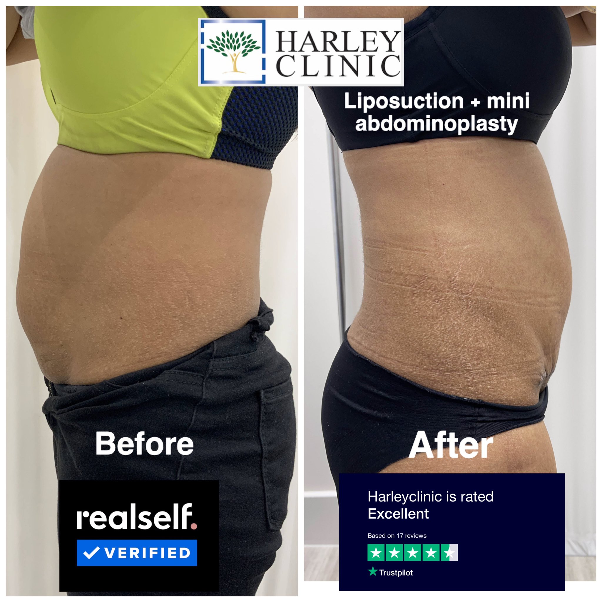 Pictures Swelling After Tummy Tuck Dr Riaz Agha على X "1 Week — free download