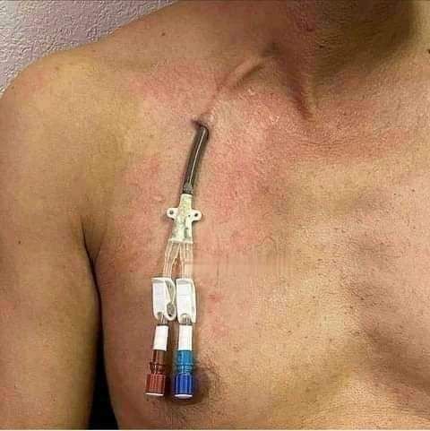 IhabFathiSulima's tweet photo. This is #permacath. What primarily organ failure the patient is suffering from ? https://t.co/eQ3w8zbXsf