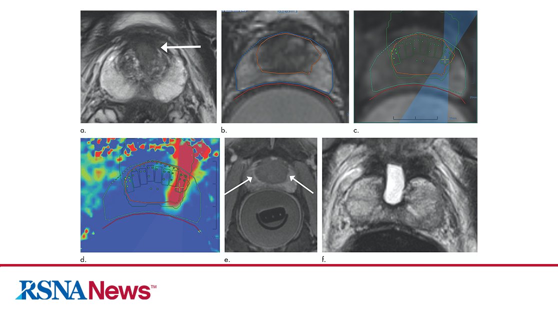 A technique that delivers high-intensity focused ultrasound to targeted tissue under #MRI guidance effectively treats intermediate-risk prostate cancer with minimal side effects, according to a study published in <a href="/radiology_rsna/">Radiology</a>: bit.ly/3aGWUvp
