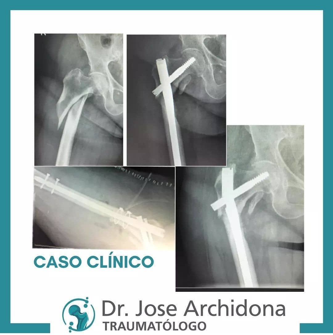 CASO CLÍNICO
👉🏼 Mujer de 79 años que acude al Servicio de Urgencias por presentar dolor en la cadera derecha traumática, es diagnosticada de fractura subtrocanterea de cadera

Post completo en 👉🏼 instagram.com/p/CKTaH3sh-5_/…

#josearchidonatraumatologo #Murcia #traumatologia