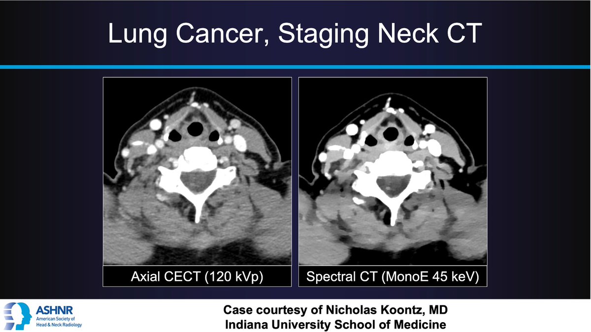 ASHNR (@ashnrsociety) on Twitter photo #ASHNRCOTW #137: Lung cancer, staging neck CT. Diagnosis? Thx <a href="/nakoontz/">Nicholas Koontz</a> <a href="/IURadiology/">IU Radiology and Imaging Sciences</a> 4 case! #ASHNR21
Answer w/ appropriate GIF only -- stay professional & don't spoil it!
<a href="/IlonaSchmalfuss/">Ilona Schmalfuss</a> <a href="/callyrobs/">Caroline Robson, MBChB</a> <a href="/DShatzkes/">Deborah Shatzkes</a> <a href="/CDP_Rad/">C Douglas Phillips 🇺🇸</a> <a href="/rhwiggins/">Richard Wiggins</a> <a href="/cmtomblinson/">Courtney Tomblinson, MD</a> @CincyPedsNeuro <a href="/ESHNRSociety/">ESHNR</a> #ASHNRCOTW #137: Lung cancer, staging neck CT. Diagnosis? Thx <a href="/nakoontz/">Nicholas Koontz</a> <a href="/IURadiology/">IU Radiology and Imaging Sciences</a> 4 case! #ASHNR21
Answer w/ appropriate GIF only -- stay professional & don't spoil it!
<a href="/IlonaSchmalfuss/">Ilona Schmalfuss</a> <a href="/callyrobs/">Caroline Robson, MBChB</a> <a href="/DShatzkes/">Deborah Shatzkes</a> <a href="/CDP_Rad/">C Douglas Phillips 🇺🇸</a> <a href="/rhwiggins/">Richard Wiggins</a> <a href="/cmtomblinson/">Courtney Tomblinson, MD</a> @CincyPedsNeuro <a href="/ESHNRSociety/">ESHNR</a>