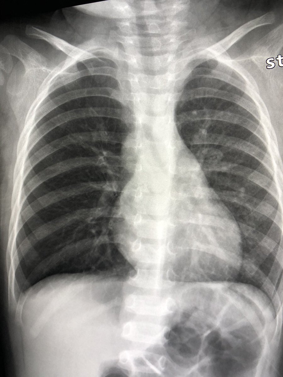 samrad77's tweet photo. In children with asymmetrical hyperinflated hyperlucent lung with paucity of bronchovascular markings- think of airway foreign body. 

#radres #Pediatrics https://t.co/lhsR86qjuq