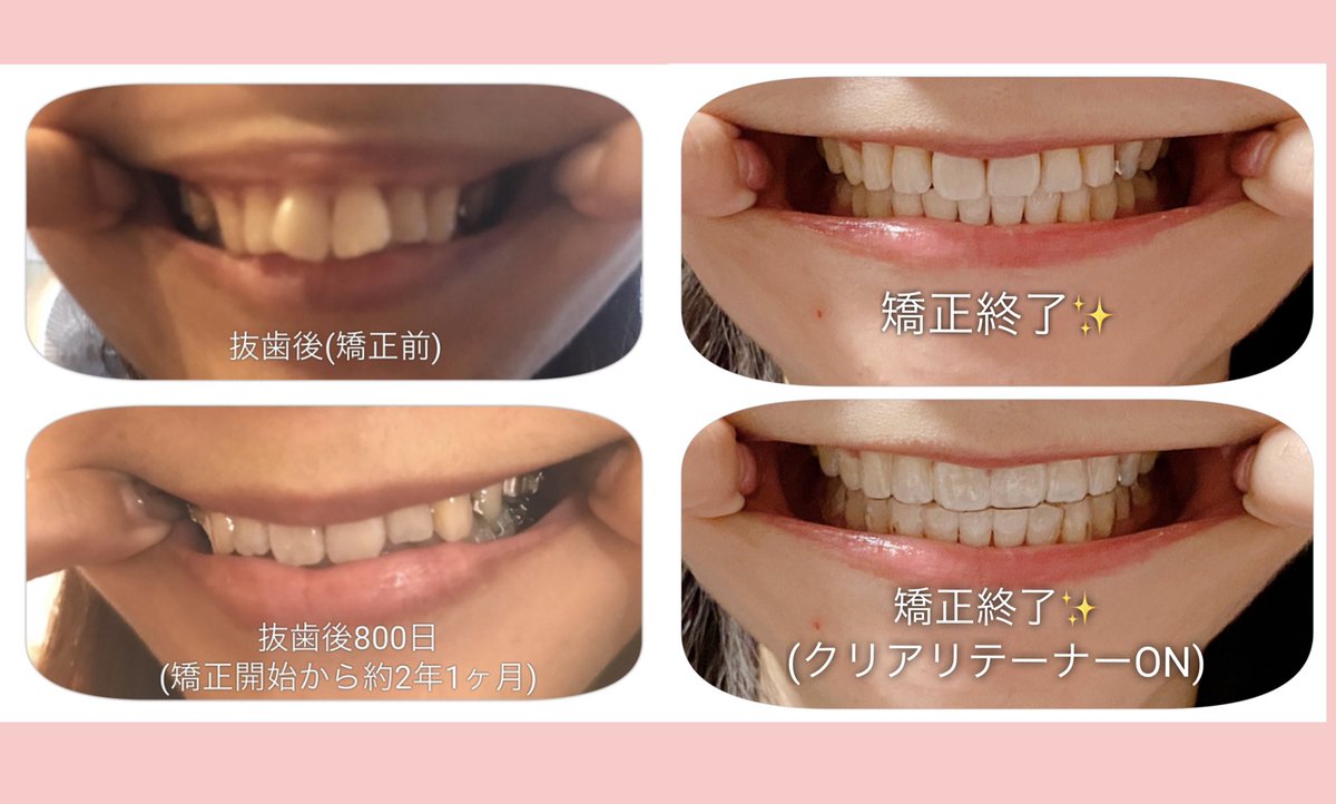 前歯 X 矯正 Hotワード