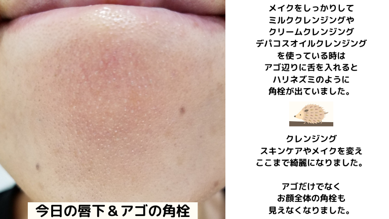 りと 敏感肌 毛穴 毛穴ﾎﾞｺﾎﾞｺﾏﾏ 角栓に関しては 頬や鼻も普通に確認できるレベルだったのが全て小さくなりました 角栓が気になってる人は参考にしていただければ嬉しいです 私はysラボのオリーブスクワランを使っています ダントツ無臭 オイルは