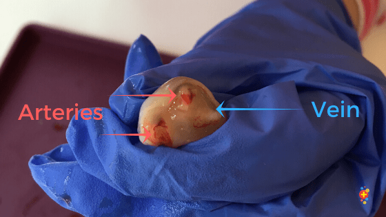 The cord starts off life as the yolk stalk, containing the vitelline duct, fused to the body stalk containing a pair of umbilical arteries, a single umbilical vein + the allantois. The vitelline duct obliterates around week 8 of fetal life.Single artery is a common variant2/9