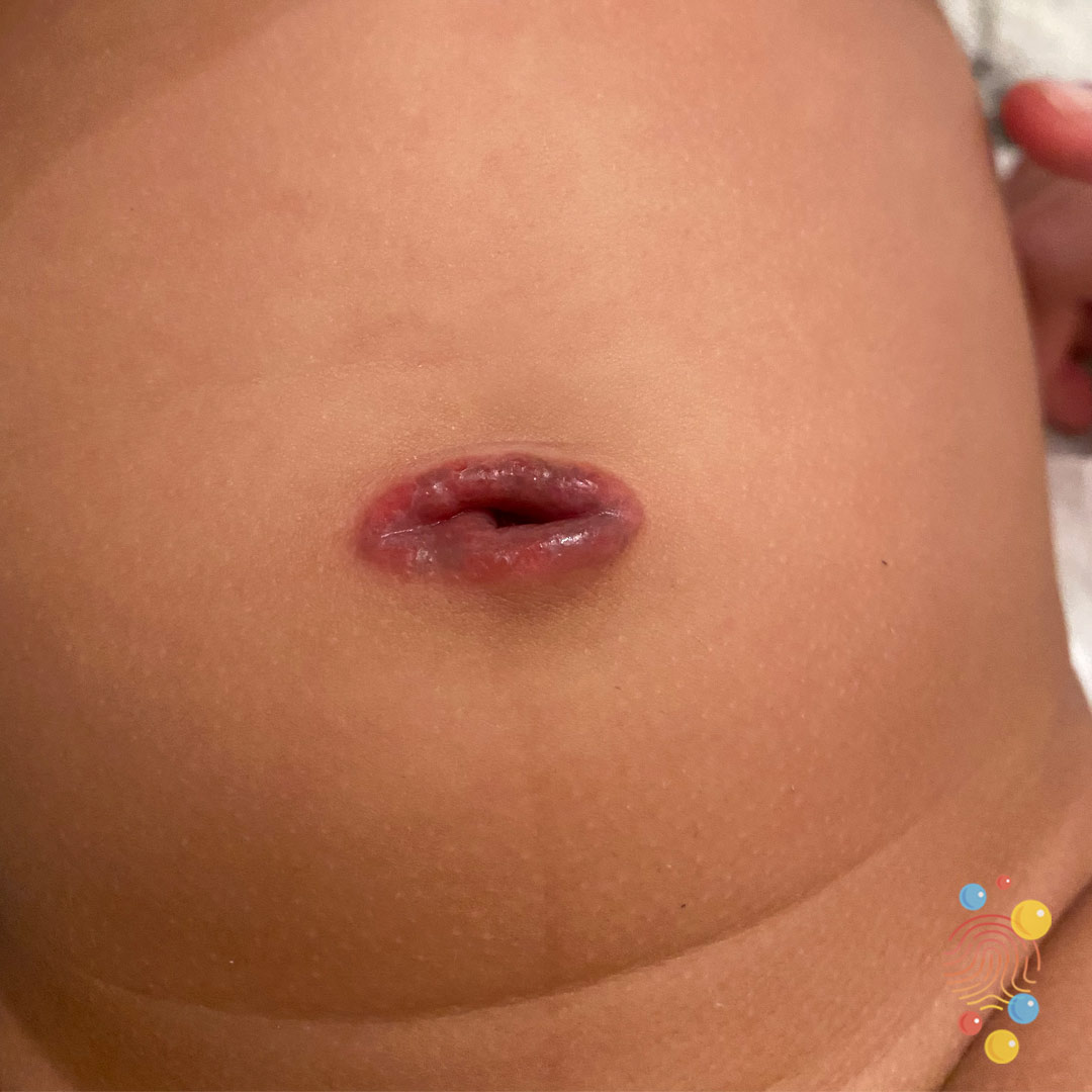 Keep an eye out for vitellointestinal or urachal ducts. These are duct remnants with a sinus/communication. A ‘granuloma’ not resolving with treatment, one that looks different from normal granulomas, or if it’s discharging urine or serious fluid – consider a duct remnant 7/9