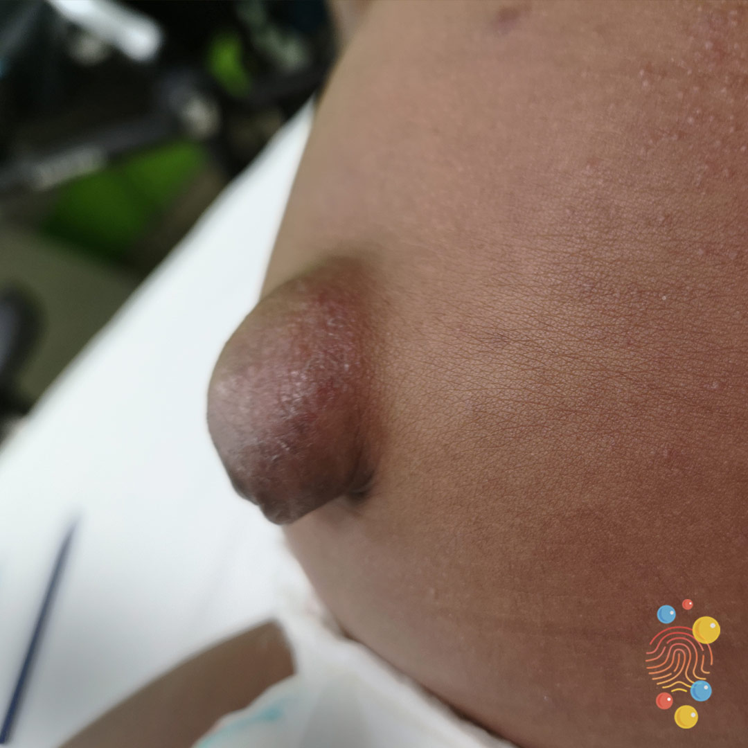 Umbilical hernias are common: more so in premature babies + those with Trisomy 21. It’s normally painless but it’s more noticeable when the child cries.Most close spontaneously. The larger ones are less likely to close + may need surgery. It’s rare they become incarcerated8/9