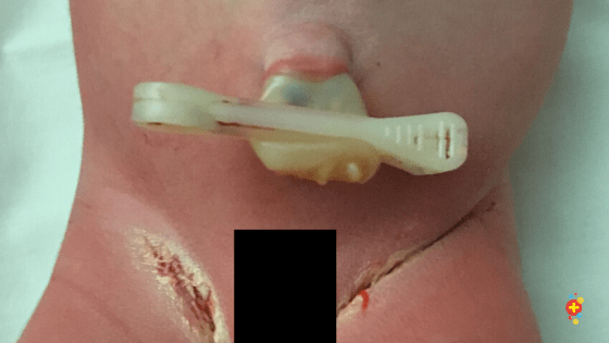 A normal cord  is the colour of freshly cooked calamari. It might be a bit green due to meconium staining. It will dry up + drop off around Day 8. Be careful with delayed cord separation – increased risk of omphalitis + immune disorders e.g. leukocyte adhesion deficiency3/9