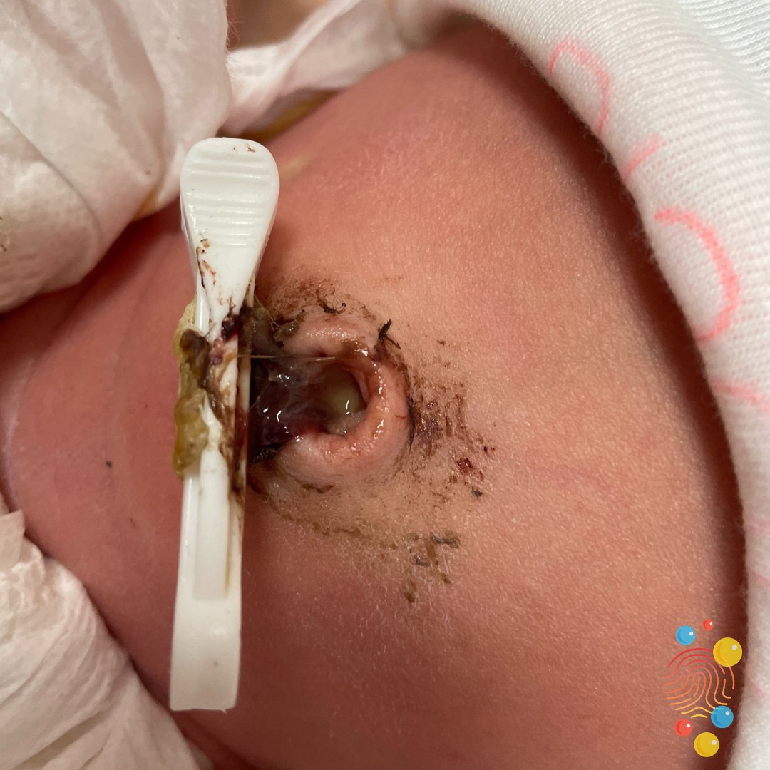 Then the cord dries up + falls off. It can be smelly, and can have a bit of discharge. It’s flesh that’s dying + falling off the body – it’s a mucky process. Often they just need a gentle clean with gauze and water.4/9