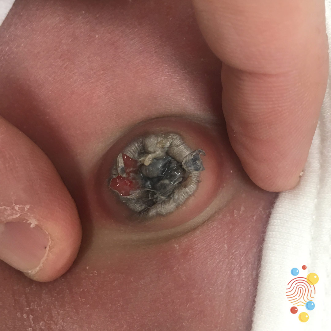 We worry about omphalitis. This isn’t common. The skin around the cord on the abdomen gets red and angry looking. The stump is a good breeding ground for bacteria. Most commonly caused by Staph, Strep, and E. coli.Babies can become very sick and need IV antibiotics. 5/9