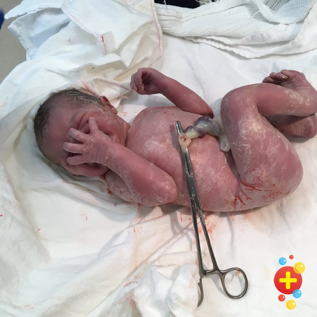 Umbilical cords – we all had one once. In neonates they cause a myriad of potential problems – sticky, discharging, smelly, pink, lumpy, protruding, Do you know what’s what when it comes to cord problems? A thread: (See dontforgetthebubbles.com/the-normal-neo… + DFTBSkinDeep.com) 1/9