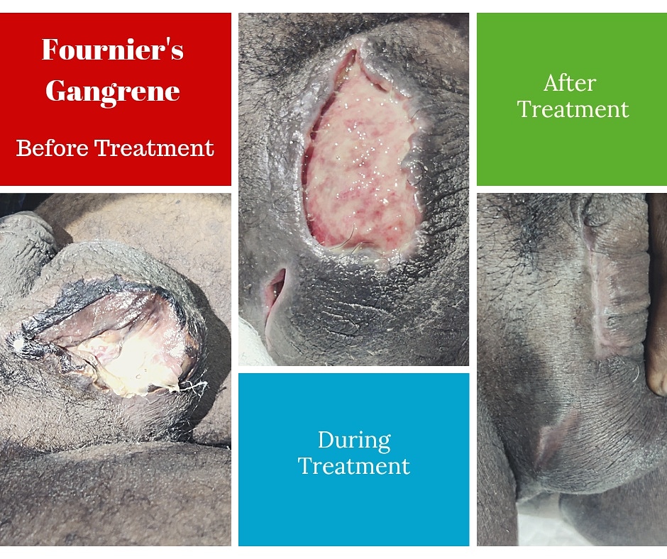 Fournier's Gangrene