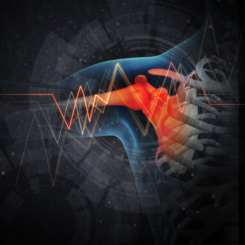 MillettMD's tweet image. In this biomechanical model, the classic technique of the #Latarjetprocedure provided a greater surface area for healing to the glenoid and superior initial fixation when compared with the congruent-arc technique.