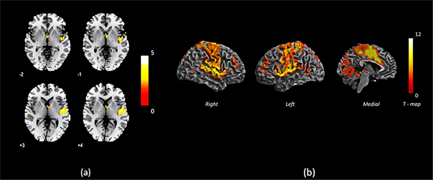 SIRSGlobal's tweet photo. 1/2 Studying whole-brain binarized degree centrality maps of 31 patients with first episode #psychosis, compared to healthy controls, @avyarthanadey et al observed reduced centrality of a right superior temporal gyrus cluster. @Nature_NPJ #npjshcz https://t.co/RWSqAdG4Vp https://t.co/4D2D8xPl3r