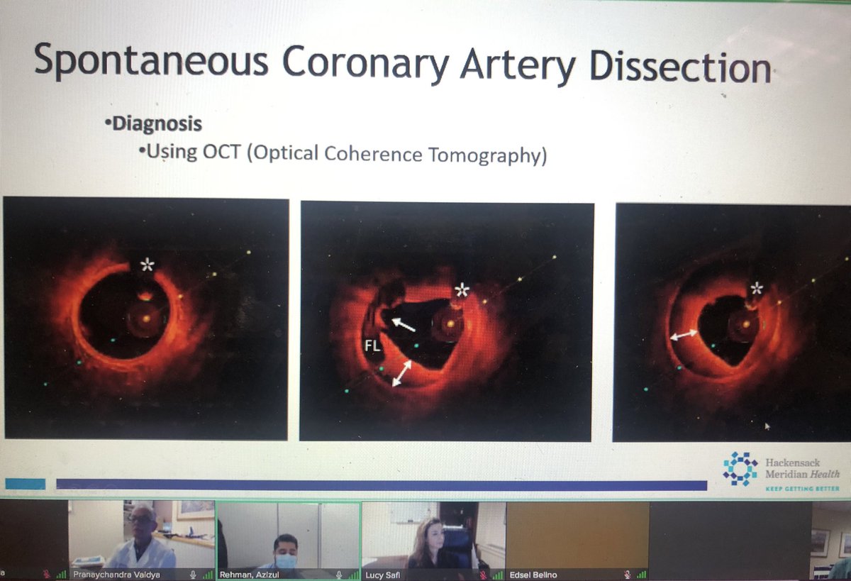 Use of #intravascularimaging #oct