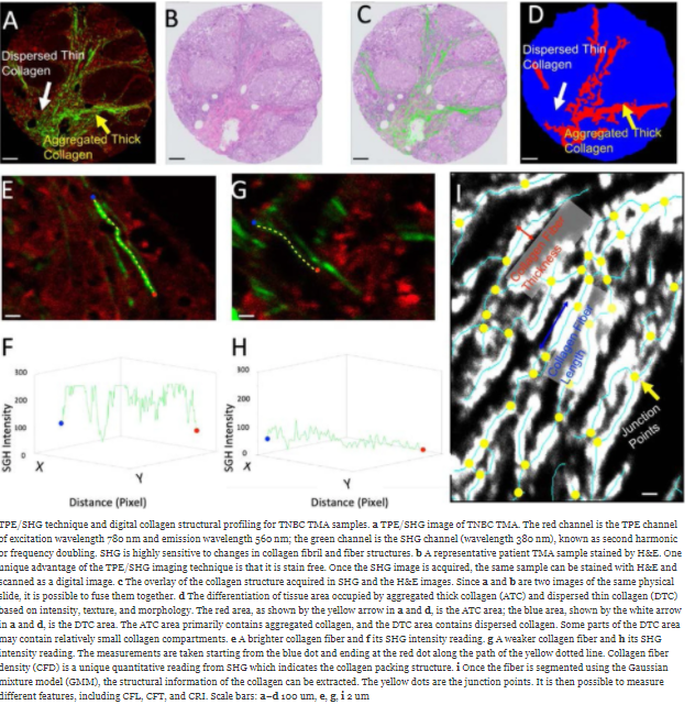 Quantitative stain-free imaging and digital profiling of collagen structure reveal diverse survival of triple negative breast cancer patients Read for free! bit.ly/3tqMzfE #Quantitativeimaging #Stroma #BreastCancer