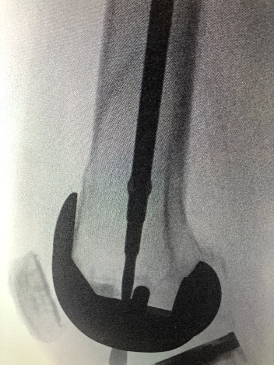 [2/5] From my prior years of being “alone” (no residents) I like to make life easier for myself so this was automatic small incision & clamp. I use fluoro heavily to help me with incision planning, so here I am drawing lines along freer to place my incision in the best position.