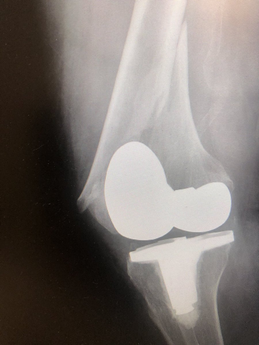 [1/5] Distal femur periprosthetic fracture. You’d be hard pressed to find someone who wouldn’t operate on this. However, I’ve seen non-ambulators with this shear pattern treated nonop & then that proximal medial fragment slowly comes out of the skin and becomes an open fx—beware!