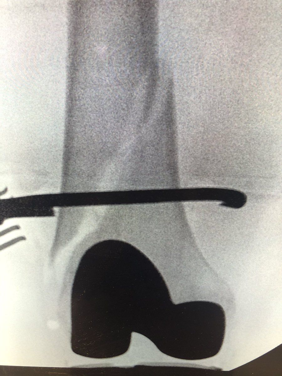 [3/5] Here is the Synthes colinear clamp reducing the fracture. Length was achieved by my resident pulling on the leg, and I got the correct rotation by putting my finger through the incision on the anterior femur, feeling the stepoff, and rotating the leg until it felt “right.”