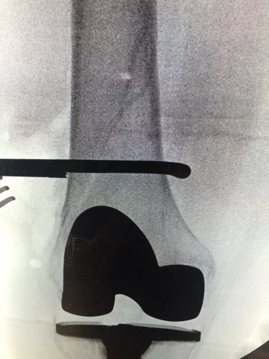 [3/5] Here is the Synthes colinear clamp reducing the fracture. Length was achieved by my resident pulling on the leg, and I got the correct rotation by putting my finger through the incision on the anterior femur, feeling the stepoff, and rotating the leg until it felt “right.”