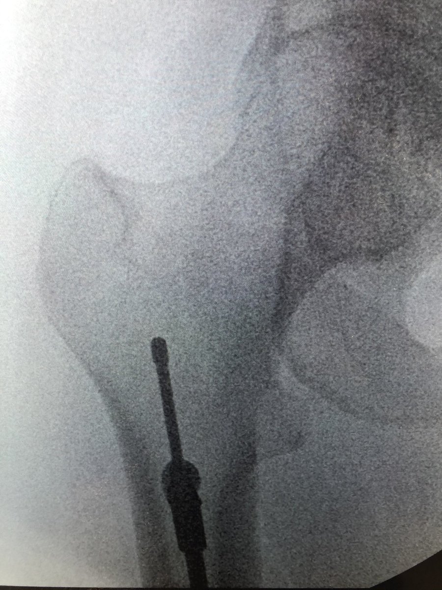 [4/5] Clamp then stayed on the entire time and retrograde nail went in. Here I am forced into posterior starting point which I knew would give me a slight malreduction problem in the end; I aimed to minimize that by keeping the clamp on until nail was locked proximal and distal.