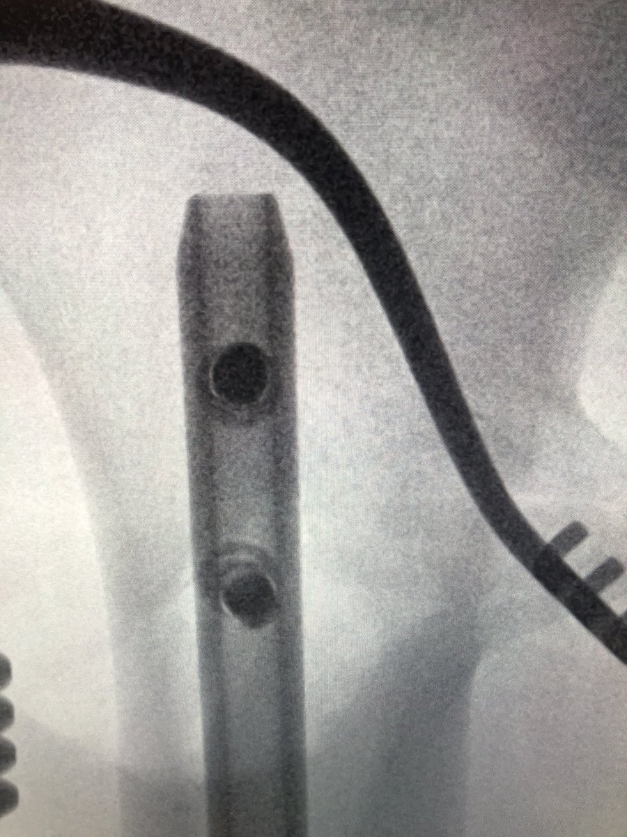 [4/5] Clamp then stayed on the entire time and retrograde nail went in. Here I am forced into posterior starting point which I knew would give me a slight malreduction problem in the end; I aimed to minimize that by keeping the clamp on until nail was locked proximal and distal.