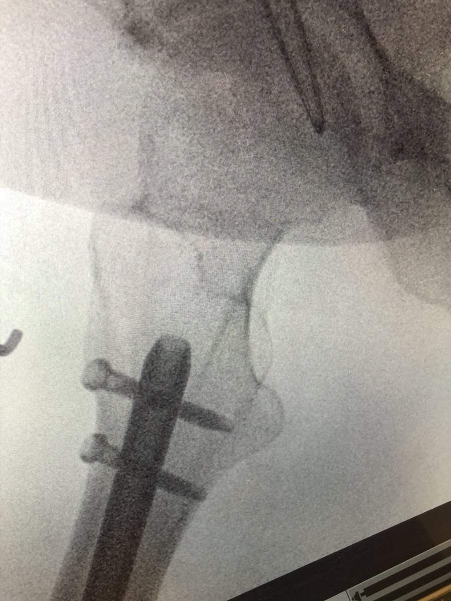 [4/5] Clamp then stayed on the entire time and retrograde nail went in. Here I am forced into posterior starting point which I knew would give me a slight malreduction problem in the end; I aimed to minimize that by keeping the clamp on until nail was locked proximal and distal.