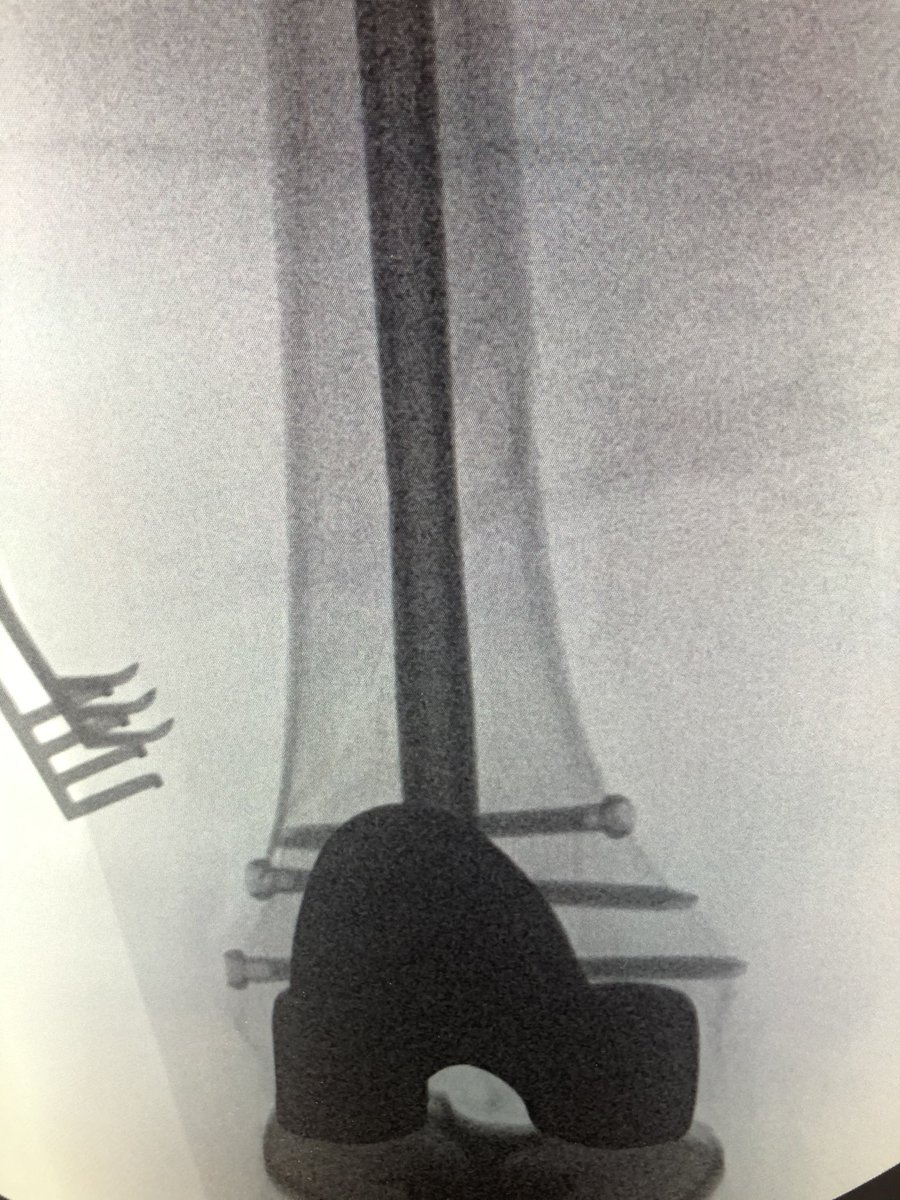 [5/5] Finals. Looks great on AP, but on lateral we still ended up with a little malreduction because starting point limited. But bone was good and 3 screws in distally, so I was not concerned. If you want a paper about which knees have a posterior start:  https://pubmed.ncbi.nlm.nih.gov/24929282/ 