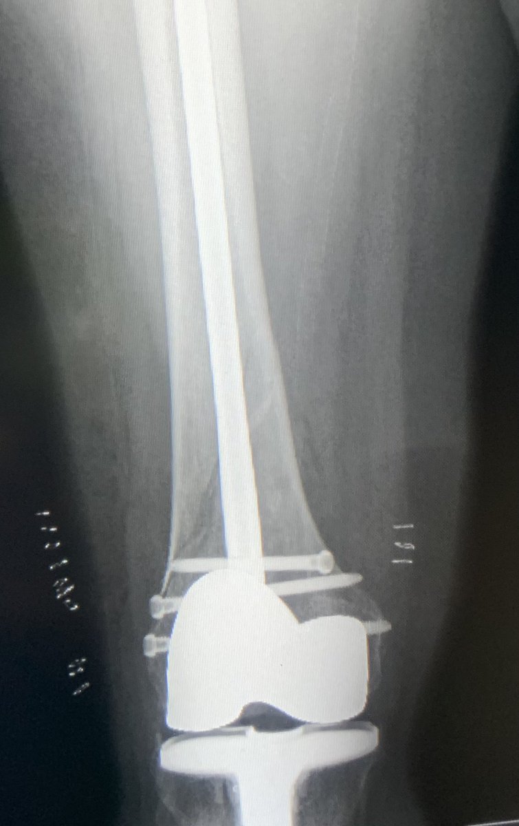 [5/5] Finals. Looks great on AP, but on lateral we still ended up with a little malreduction because starting point limited. But bone was good and 3 screws in distally, so I was not concerned. If you want a paper about which knees have a posterior start:  https://pubmed.ncbi.nlm.nih.gov/24929282/&nbsp;